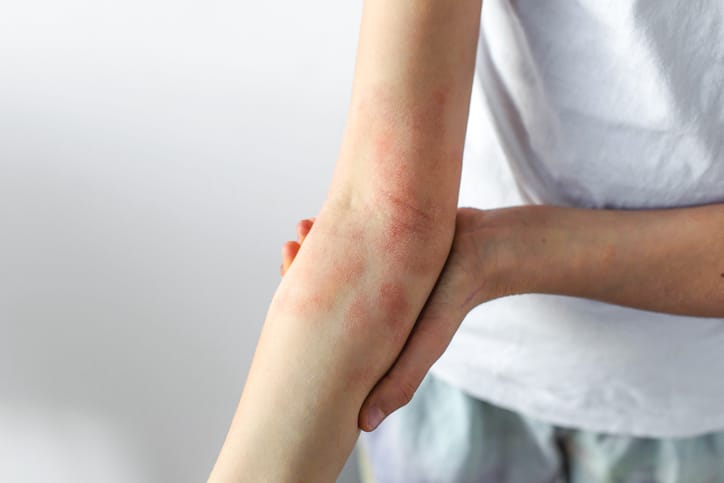 Child forearm with visible eczema irritation red patches, sensitive dry skin affected by atopic dermatitis, pediatric dermatology concept showing chronic allergy symptoms skin condition.