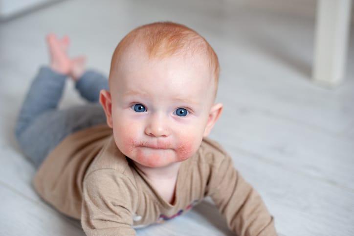 Nemours - Allergies, flaking and wounds, atopic dermatitis on the face baby eczema